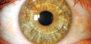 Fakik Göz İçi Lens Ameliyatı Nedir?