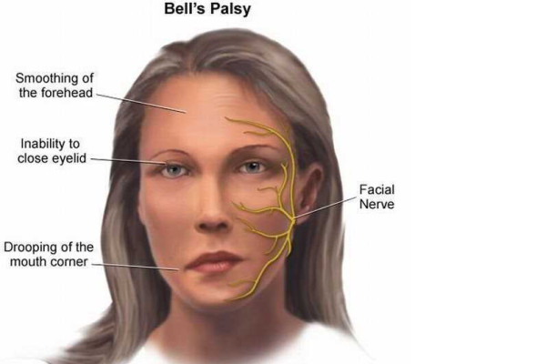 Расположение лицевого нерва на лице фото Расположение лицевого нерва на лице фото