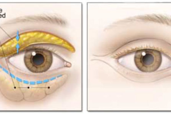 Göz Kapağı Estetiği ( Blefaroplasti )