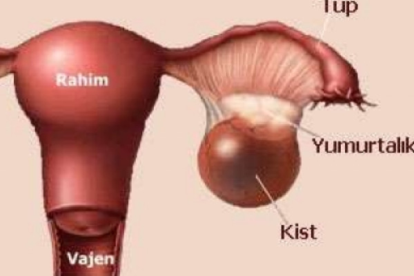 Как выглядит киста глаза Как выглядит киста глаза