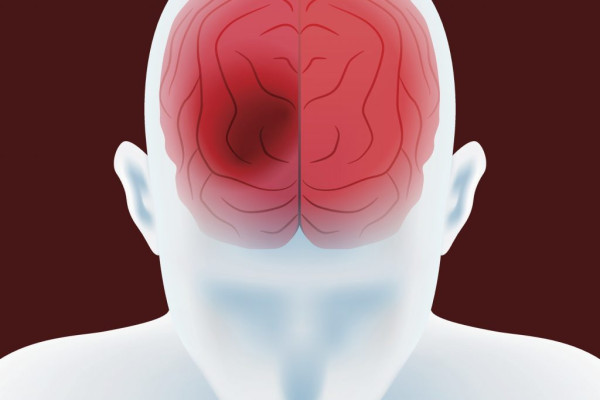 Beyin Kanaması Belirtileri, Nedenleri ve Tedavisi