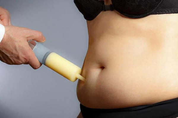 Liposuction Nedir, Nasıl Yapılır