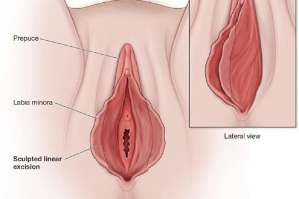 Vajinoplasti (Vajina Daraltma) Ameliyatı Nedir? Nasıl Yapılır?