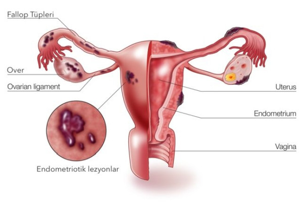 Endometriozis Nedir? Belirtileri ve Tedavisi