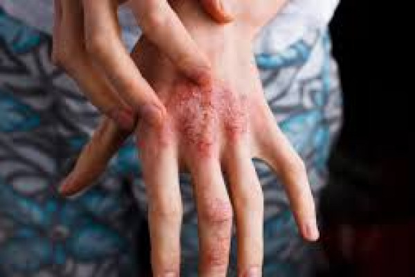 Egzama (Atopik Dermatit) Nedir? Egzama Belirtileri ve Tedavisi