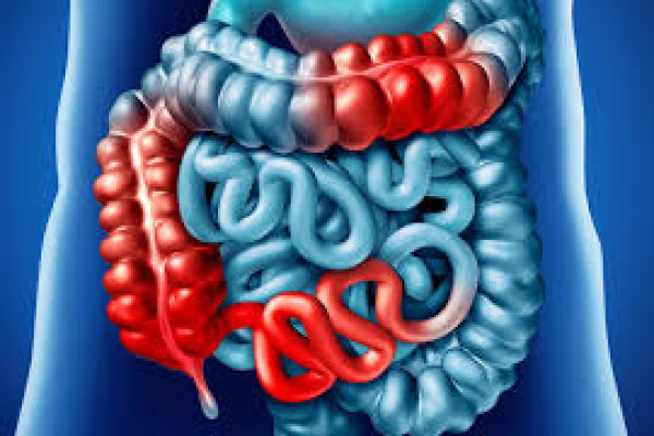 Crohn Hastalığı Nedir? Belirtileri ve Tedavi Yöntemleri