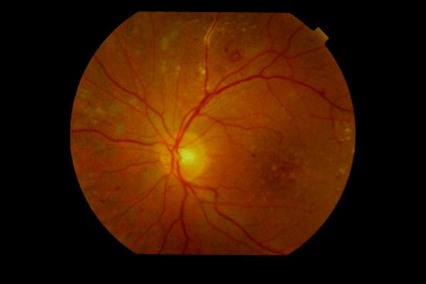 yüksek tansiyonda retinopati tedavisi birinci derece hipertansiyon ne yapmalı