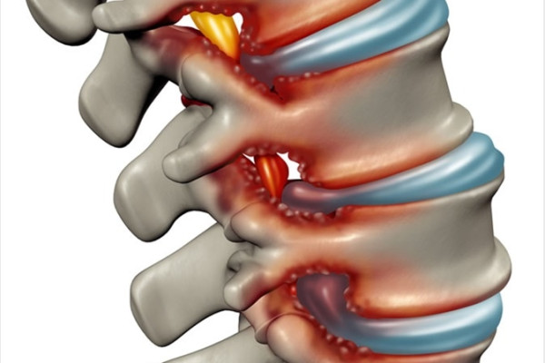 Dar kanal ( Spinal Stenoz ) Nedir, Belirtileri ve Tedavisi