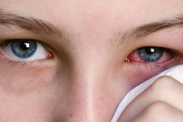 Konjonktivit ( Göz Kızarıklığı) Nedenleri, Belirtileri ve Tedavisi