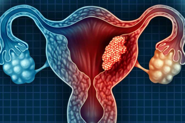 Endometriyal Kanser Nedir? Belirtileri ve Tedavisi